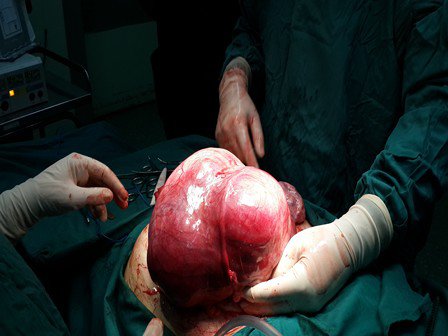 خارج کردن توده پنج کیلویی از شکم بیمار +عکس خارج کردن توده پنج کیلویی از شکم بیمار +عکس