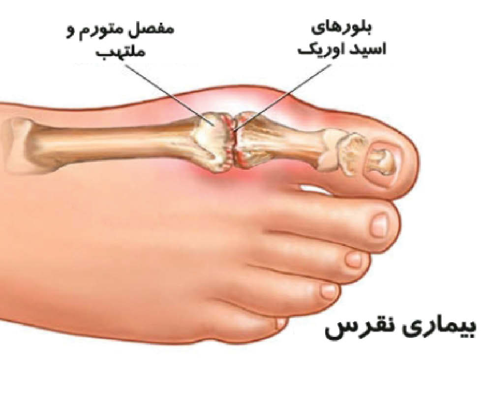 راه های کاهش اسید اوریک بالا راه های کاهش اسید اوریک بالا