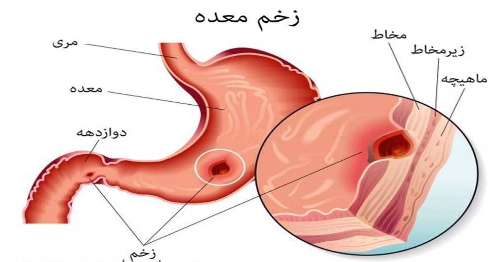 این داروها معده را نابود میکنند! این داروها معده را نابود میکنند!