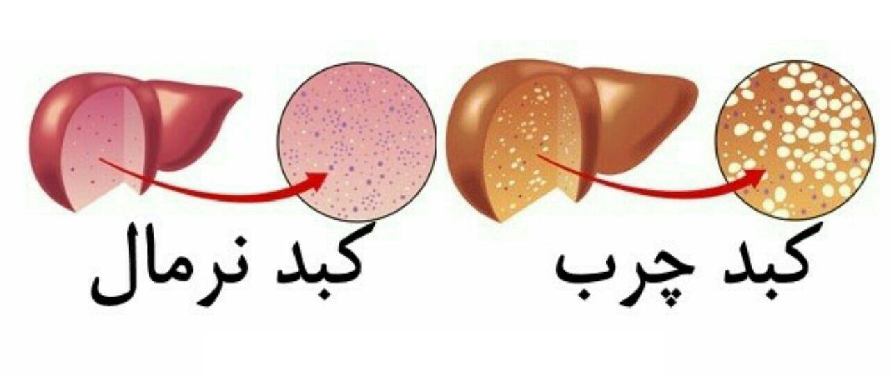 درمان کبد چرب؛ فقط با یک تغییر در رژیم غذایی درمان کبد چرب؛ فقط با یک تغییر در رژیم غذایی