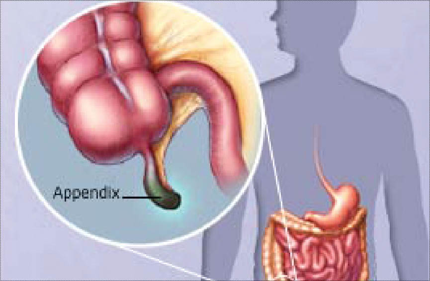 علامت التهاب آپاندیس چیست؟ علامت التهاب آپاندیس چیست؟