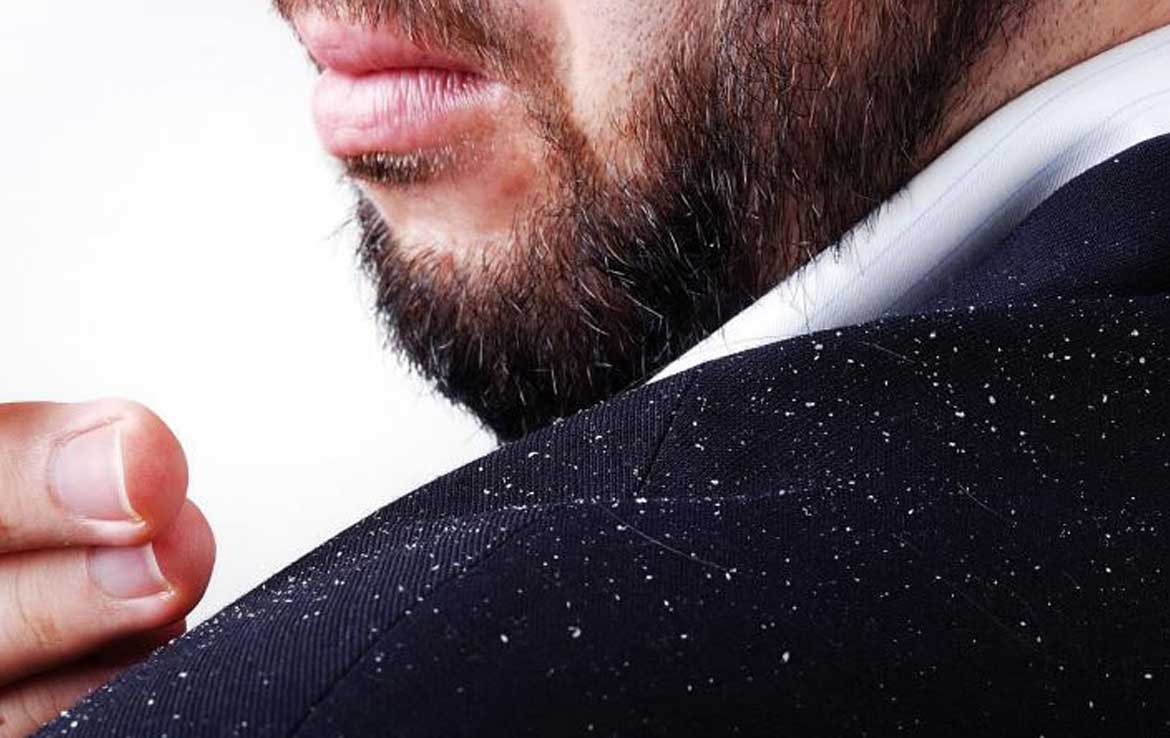 علت شوره سر چیست؟ علت شوره سر چیست؟