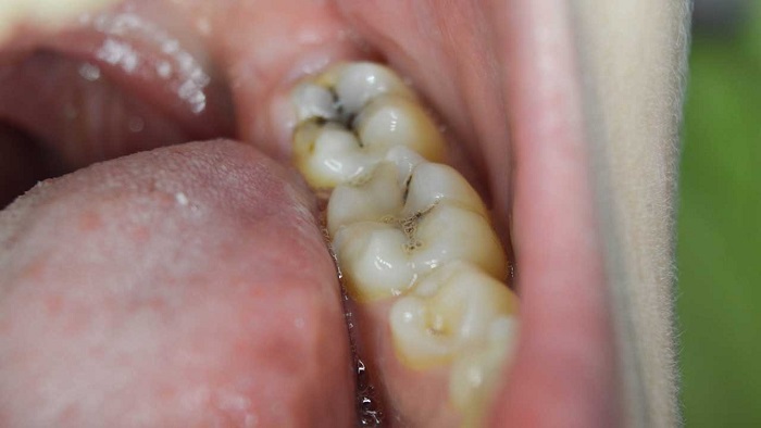 رابطه باکتری دهان و سرطان کولورکتال رابطه باکتری دهان و سرطان کولورکتال
