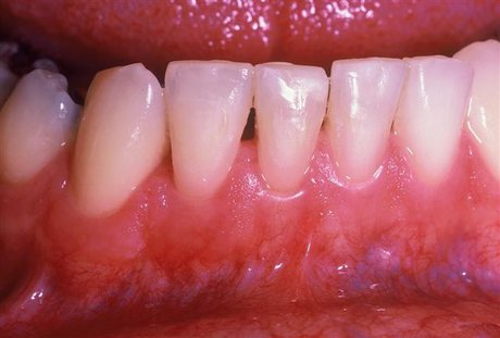 خطرات غیرمنتظره بیماری لثه را بشناسیم! خطرات غیرمنتظره بیماری لثه را بشناسیم!