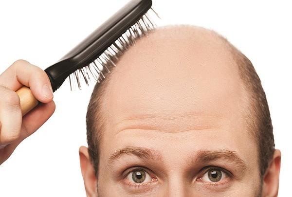 ریزش روزی چند تار مو طبیعی است؟ ریزش روزی چند تار مو طبیعی است؟