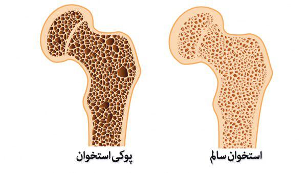 مولکول موثر در بروز پوکی استخوان، شناسایی شد مولکول موثر در بروز پوکی استخوان، شناسایی شد