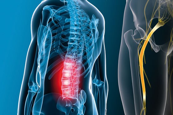 چگونه دردرهای سیاتیک را درمان کنم؟ چگونه دردرهای سیاتیک را درمان کنم؟
