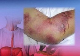 تب کریمه کنگو واکسن ندارد تب کریمه کنگو واکسن ندارد