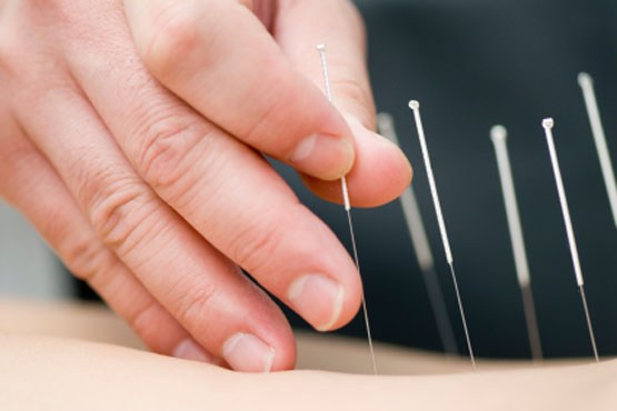 طب سوزنی و تاثیر آن در درمان چین و چروک صورت طب سوزنی و تاثیر آن در درمان چین و چروک صورت