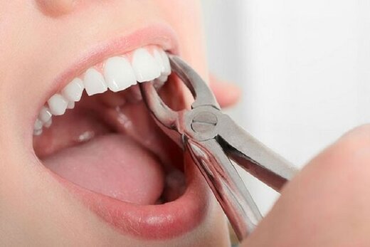 ورزش بر سلامت دندانها تاثیر منفی میگذارد؟ ورزش بر سلامت دندانها تاثیر منفی میگذارد؟