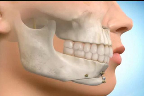 بهترین سن درمان ناهنجاری فک چه موقع است؟ بهترین سن درمان ناهنجاری فک چه موقع است؟