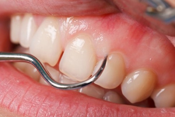 دلیل خونریزی لثه چیست؟ دلیل خونریزی لثه چیست؟