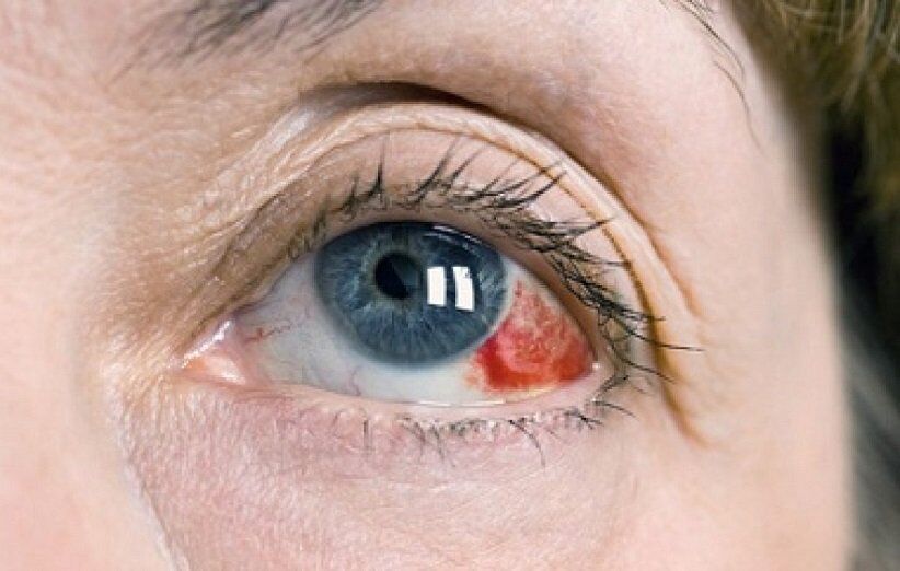 دلیل ایجاد لکههای قرمز در سفیدی چشم دلیل ایجاد لکههای قرمز در سفیدی چشم