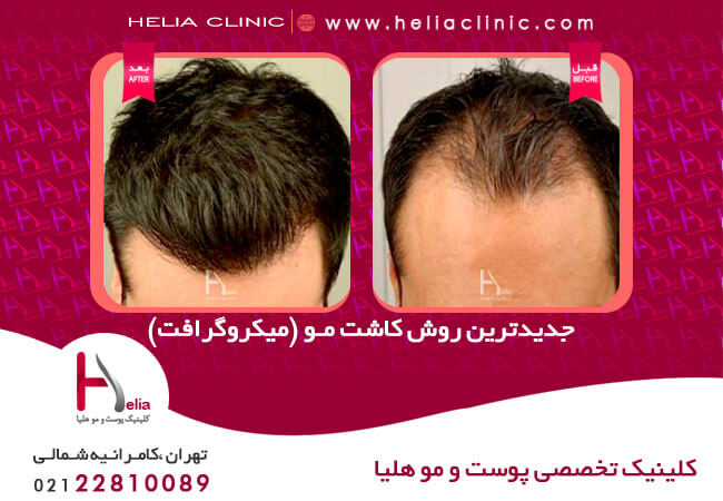 مقایسه روش های کاشت مو و ابرو در کلینیک هلیا