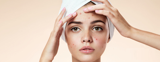 راههای سریع کاهش آکنه و جوش روی صورت راههای سریع کاهش آکنه و جوش روی صورت