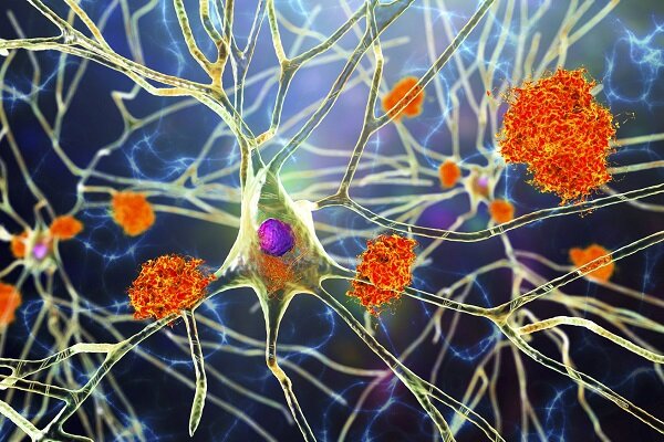 درمان آلزایمر با نور و اکسیژن درمان آلزایمر با نور و اکسیژن