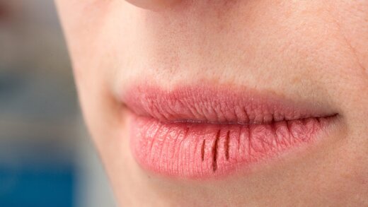 علت ترک خوردن لب ها چیست؟ علت ترک خوردن لب ها چیست؟