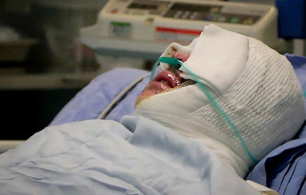 اسید؛ بهای سنگین خواستگاری نافرجام اسید؛ بهای سنگین خواستگاری نافرجام