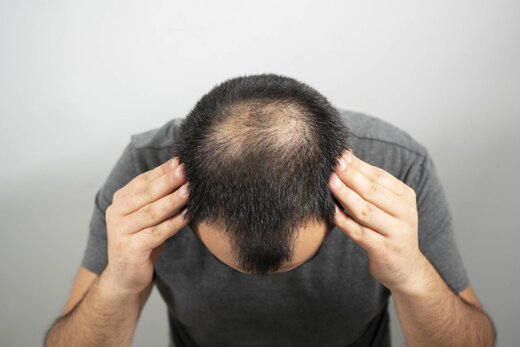 روش های سریع ترمیم موهای ریخته روش های سریع ترمیم موهای ریخته