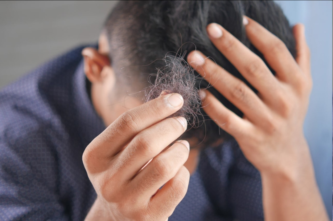 چرا پس از کاهش وزن ریزش مو میگیریم؟ چرا پس از کاهش وزن ریزش مو میگیریم؟