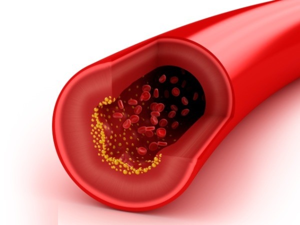 چربی خون بالا چه عوارضی ایجاد می کند؟