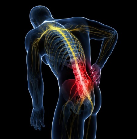 بیرون زدگی دیسک کمر چرا و به چه علت؟ بیرون زدگی دیسک کمر چرا و به چه علت؟
