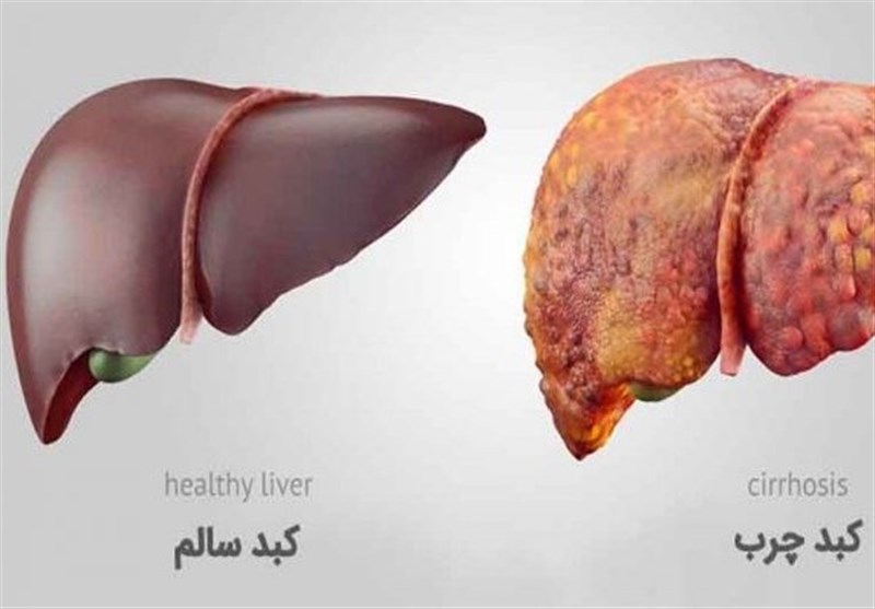 تبدیل کبد چرب به سالم تبدیل کبد چرب به سالم