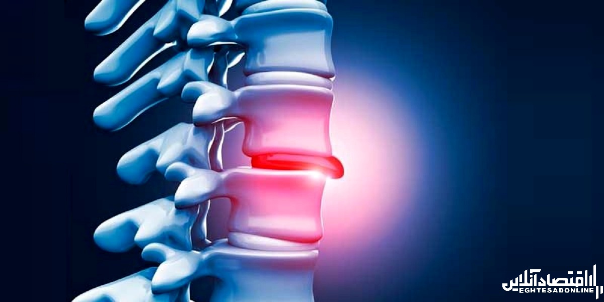 دیسک فتق شده کمر: آیا باید جراحی کنم؟ دیسک فتق شده کمر: آیا باید جراحی کنم؟
