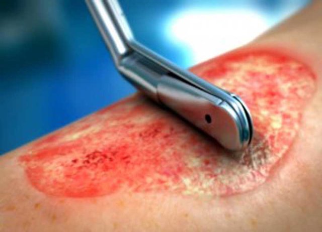 راهکاری برای بهبود سریع زخم دیابتی راهکاری برای بهبود سریع زخم دیابتی