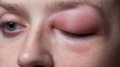 آنژیوادم؛ از یک کهیر ساده تا مرگ! آنژیوادم؛ از یک کهیر ساده تا مرگ!
