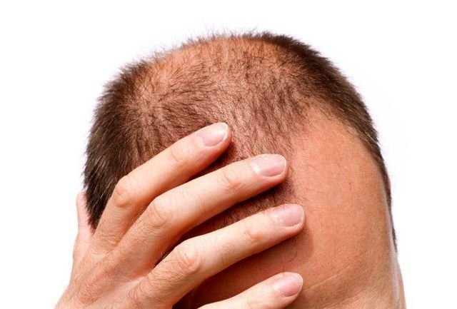 برای پیشگیری از ریزش مو چه بخوریم؟ + عکس برای پیشگیری از ریزش مو چه بخوریم؟ + عکس