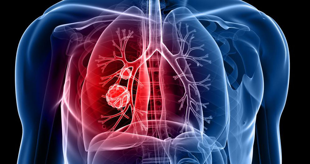 تشخیص سرطان ریه با آزمایش خون و DNA افراد تشخیص سرطان ریه با آزمایش خون و DNA افراد