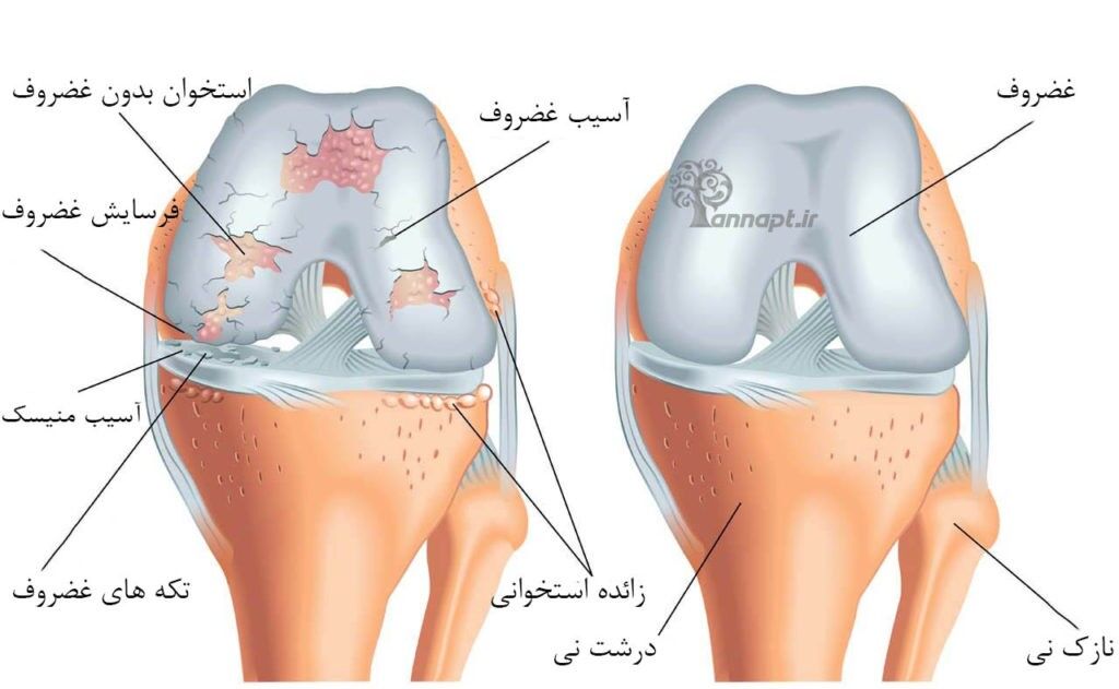 افزایش وزن و کم تحرکی آرتروز زانو را تسریع می کند افزایش وزن و کم تحرکی آرتروز زانو را تسریع می کند