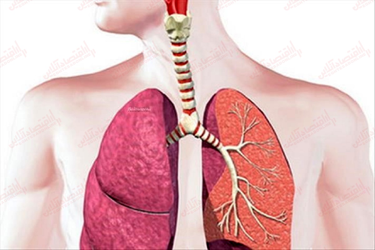 ذات الریه چیست و دلایل ابتلا به ذات الریه ذات الریه چیست و دلایل ابتلا به ذات الریه