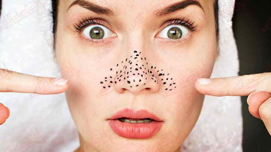 ۱۲ راه برای از بین بردن جوش های سرسیاه ۱۲ راه برای از بین بردن جوش های سرسیاه