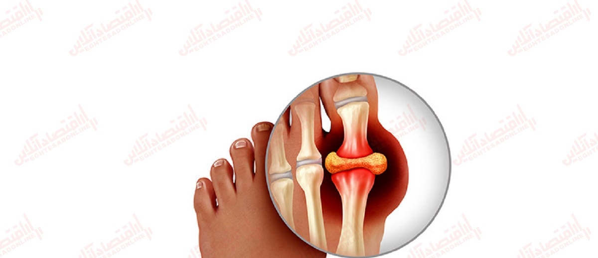 نقرس چیست؟ هر آنچه باید درباره نقرس بدانید نقرس چیست؟ هر آنچه باید درباره نقرس بدانید
