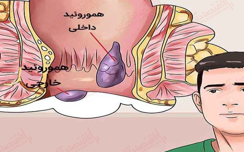 بواسیر خارجی را چگونه درمان می کنند؟ بواسیر خارجی را چگونه درمان می کنند؟
