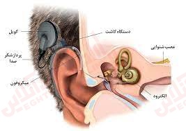 کاشت حلزونی چیست و چگونه کار می کند؟ کاشت حلزونی چیست و چگونه کار می کند؟