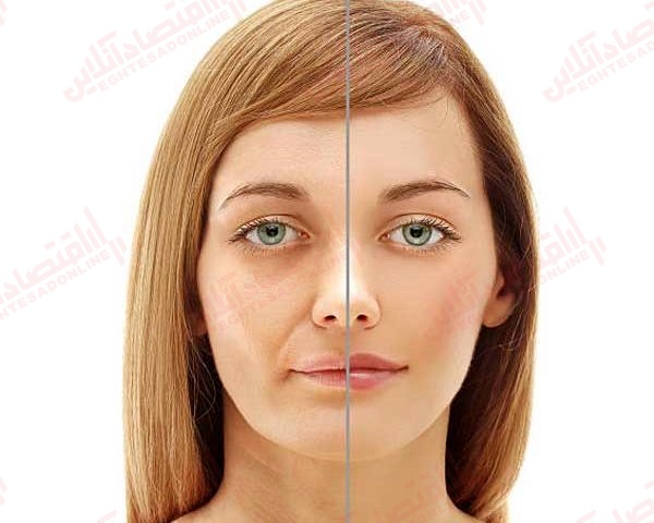فلج بل چیست؟ فلج بل چیست؟