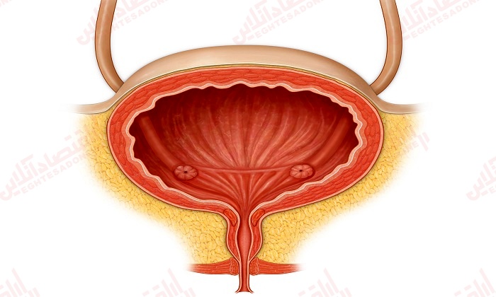 علائم افتادگی مثانه علائم افتادگی مثانه