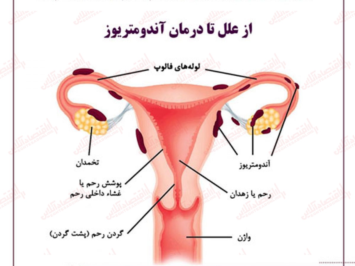 مقابله با اندومتریوز