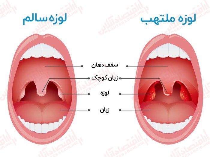 هر آنچه از التهاب لوزه باید بدانید هر آنچه از التهاب لوزه باید بدانید