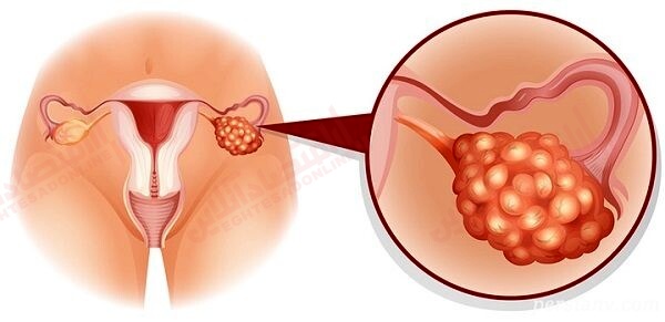 نحوه باردار شدن با سندرم تخمدان پلیکیستیک (PCOS) نحوه باردار شدن با سندرم تخمدان پلیکیستیک (PCOS)