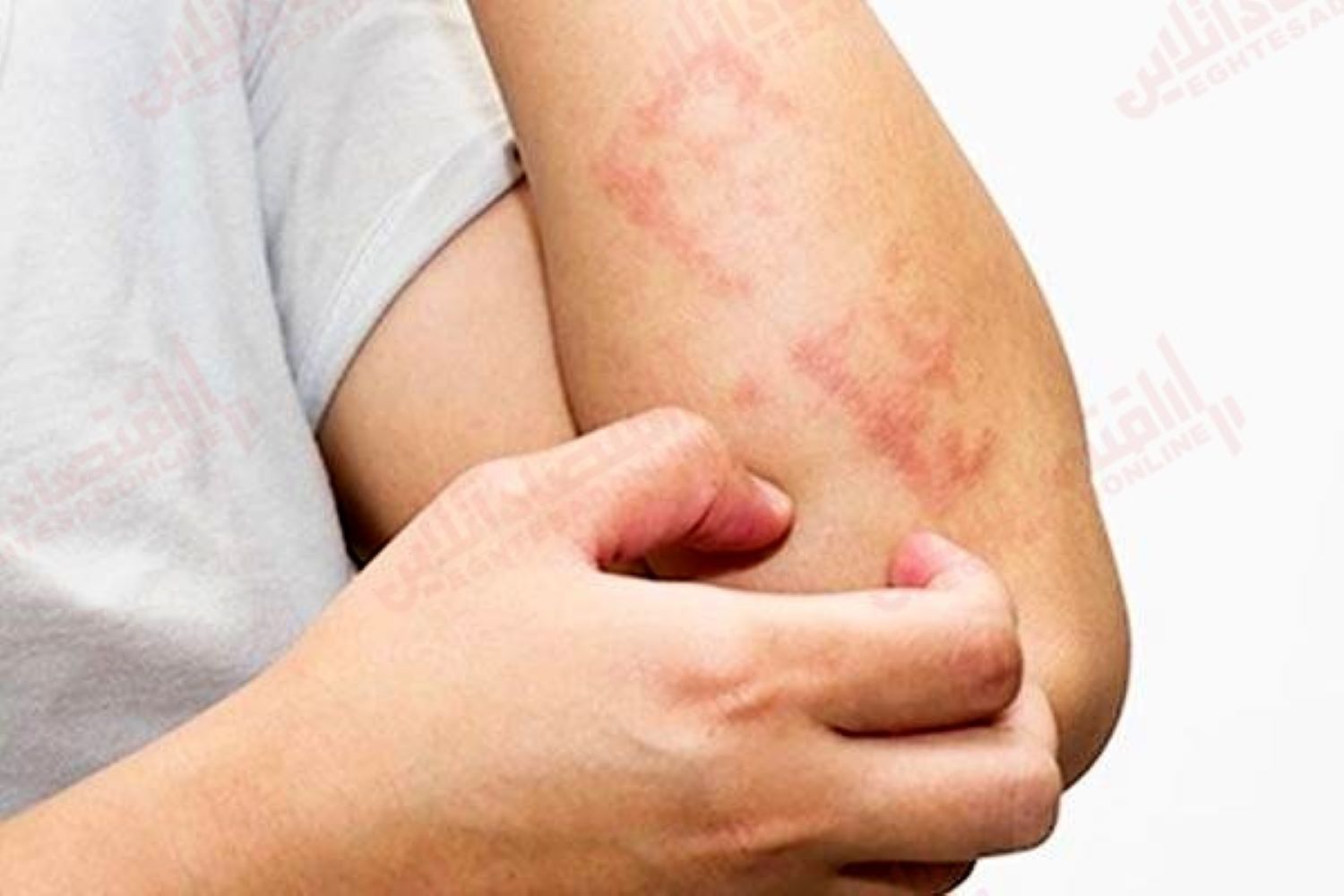 التهاب پوستی ناشی از استرس