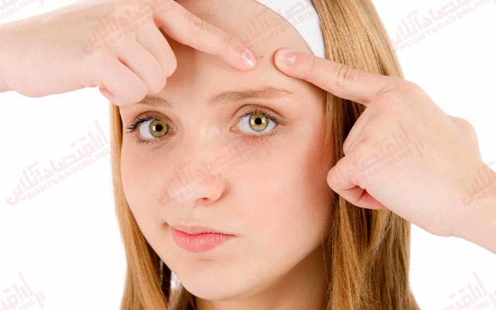 آکنه های بر روی پیشانی آکنه های بر روی پیشانی