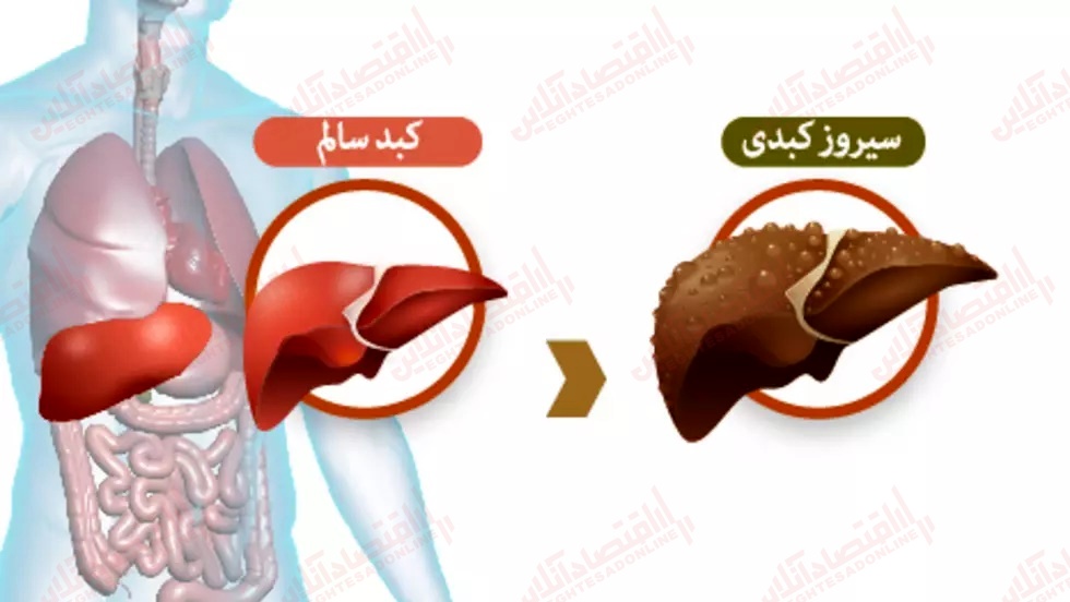 امید به زندگی در بیماران سیروز کبدی چقدر است؟ امید به زندگی در بیماران سیروز کبدی چقدر است؟