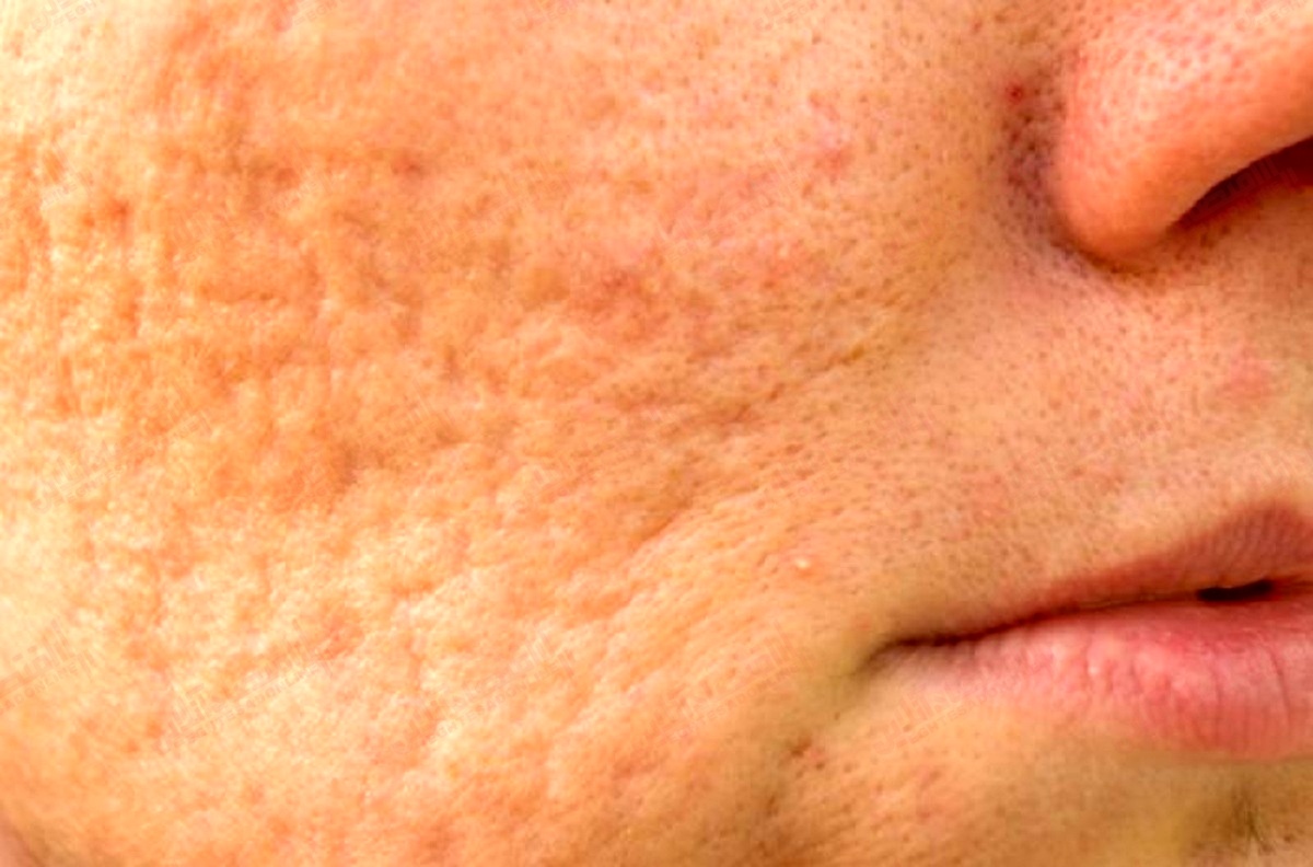 پیشنهاداتی برای تسکین و کاهش آکنه پیشنهاداتی برای تسکین و کاهش آکنه
