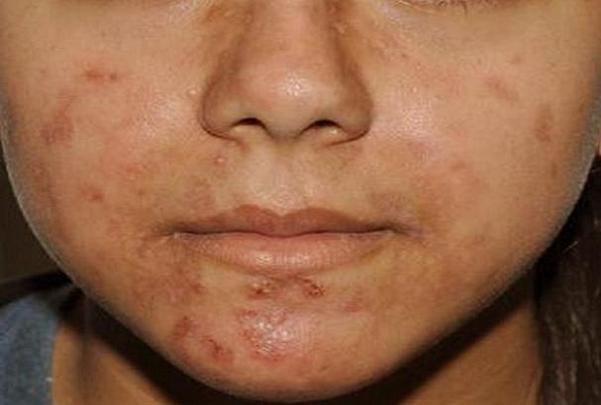 بهترین روغن های ضروری برای آکنه چیست؟ بهترین روغن های ضروری برای آکنه چیست؟