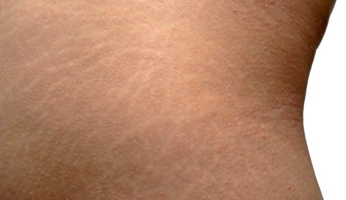 با ترک پوست چیکار کنیم؟ با ترک پوست چیکار کنیم؟