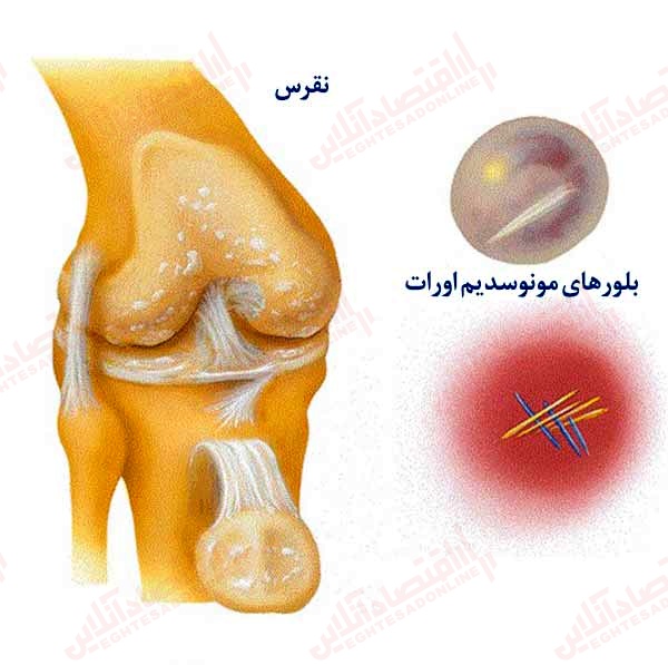 نقرس چگونه می تواند روی زانو تأثیر بگذارد نقرس چگونه می تواند روی زانو تأثیر بگذارد
